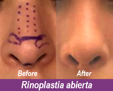 Casos de éxito, Elite Plastic Surgeon, Cirugía Plástica, rinoplastia abierta